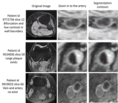 Paper: Fully automated and Robust Analysis Technique for Popliteal Artery Vessel Wall Evaluation (FRAPPE) using Neural Network Models from Standardized Knee MRI